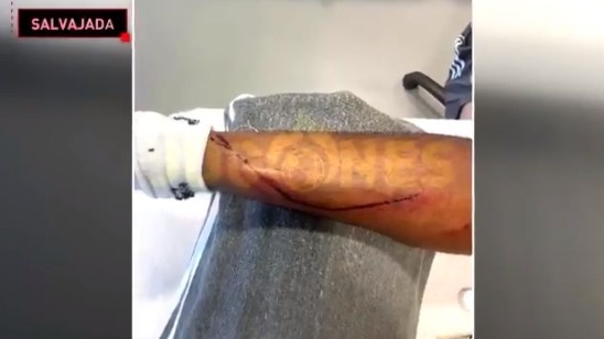 皇马小将马尔文在与格拉纳达的比赛中腿被踢破,六台赛后晒出伤口