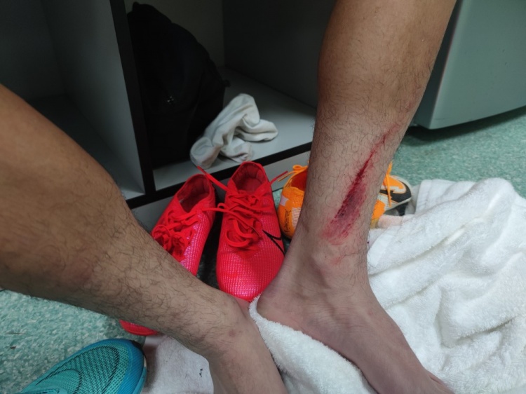 大连人小将王振澳遭对手凶狠犯规小腿留长长伤疤,带伤坚持比赛