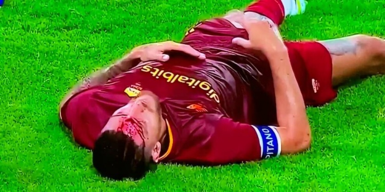 罗体：罗马队长佩莱格里尼被肘击后眉骨受伤流血不止，需要缝4针